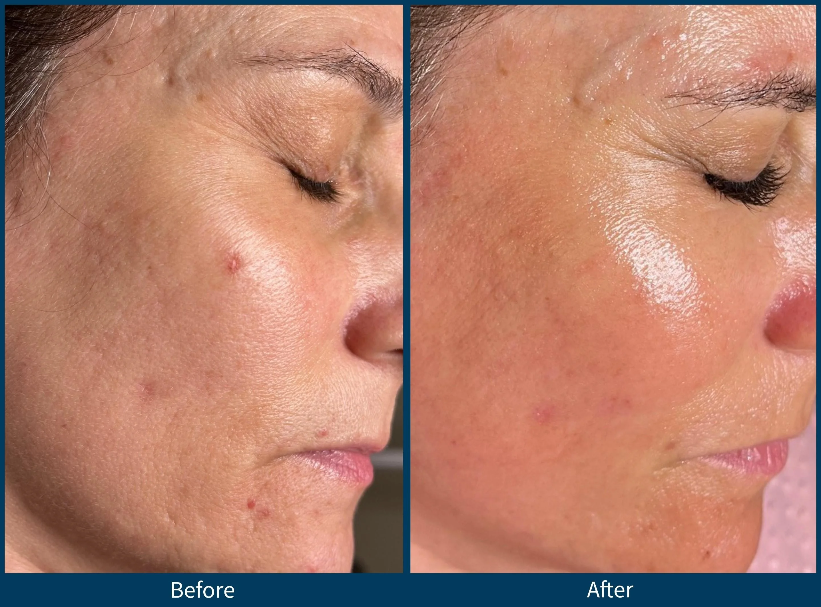 SkinPen before and After